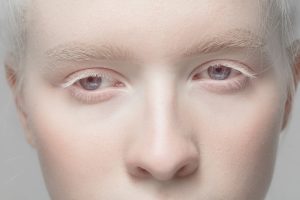 a picture of a person with albinism